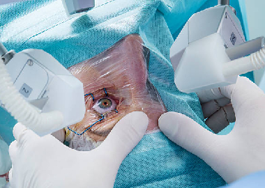 Ophthalmic surgery