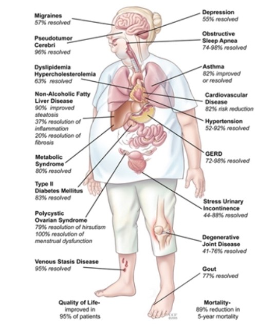 About Obesity